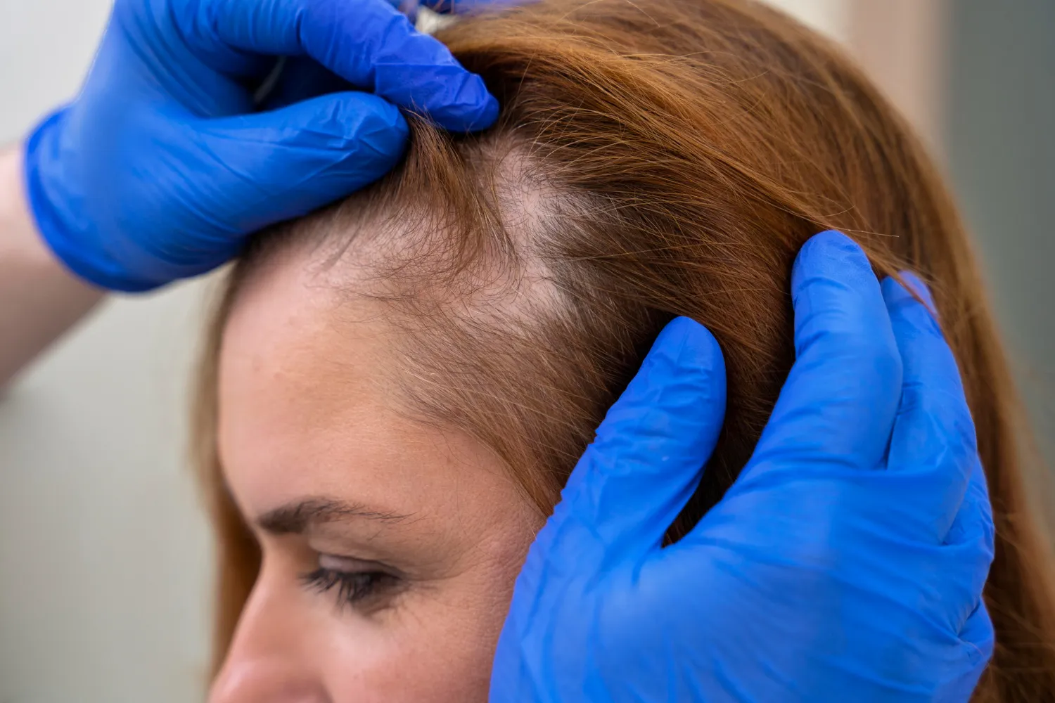 Examen du cuir chevelu avec perte de cheveux chez By-Magali, soin capillaire à Plaisance-du-Touch